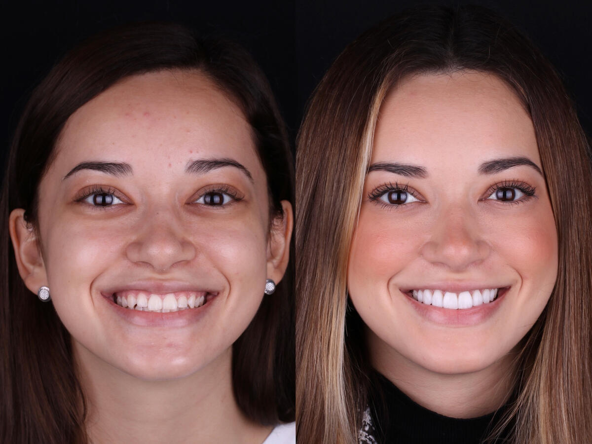 Luly 10 Veneers